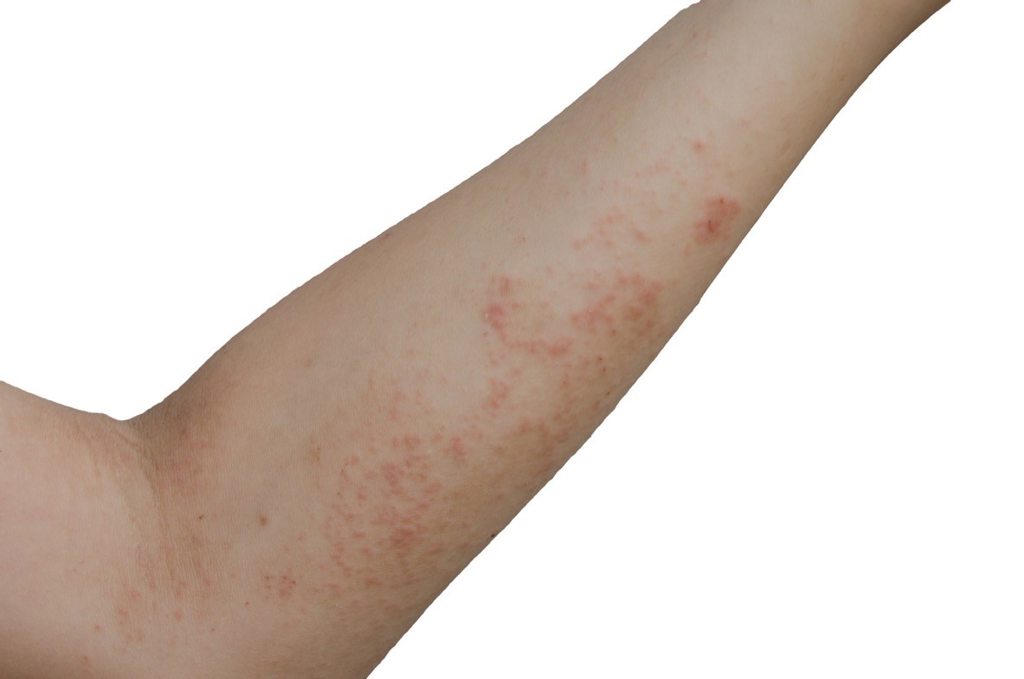 scabies bites